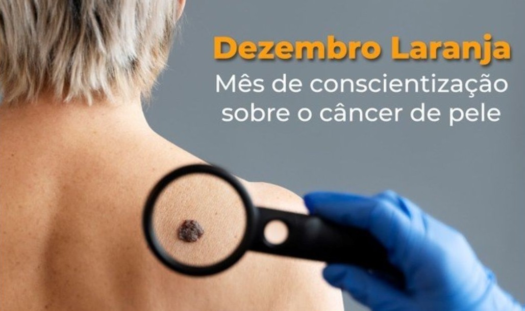 Leia mais sobre o artigo Dezembro Laranja reforça cuidados contra o câncer de pele no Espírito Santo